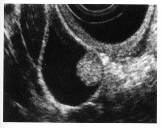 胆嚢ポリープの治療